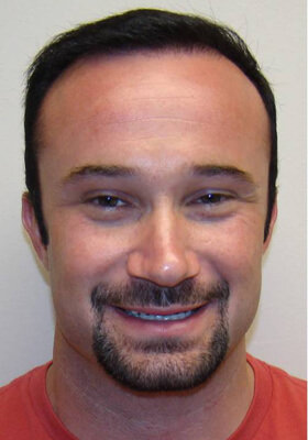 hair transplant photos