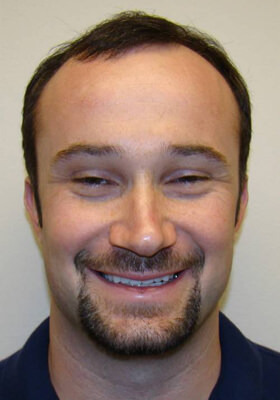 hair transplant photos