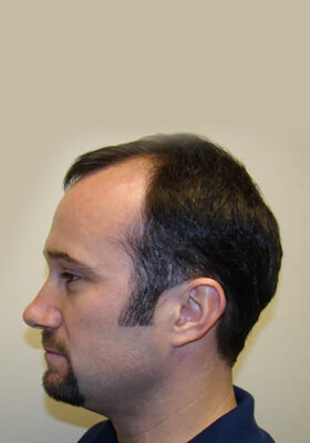 hair transplant photos