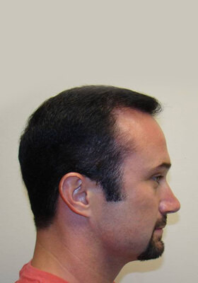 hair transplant photos