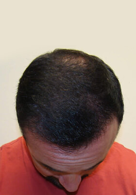 hair transplant before after Photos