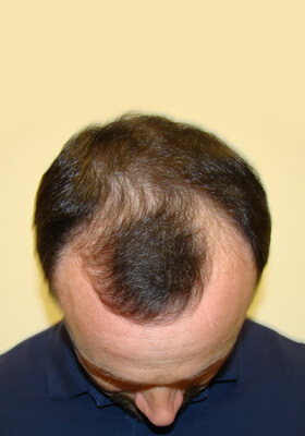 hair transplant before after Photos