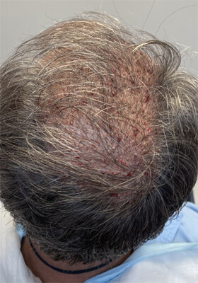 hair transplant photos