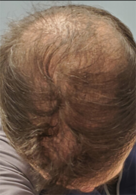 hair transplant before after Photos