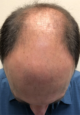 hair transplant photos