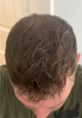 hair transplant before after Photos