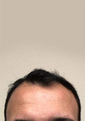 hair transplant photos