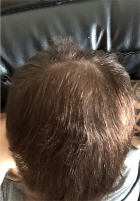 hair transplant photos