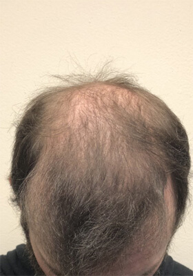 hair transplant photos