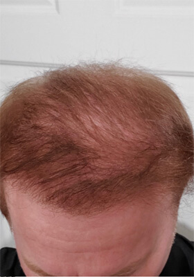 hair transplant before after Photos