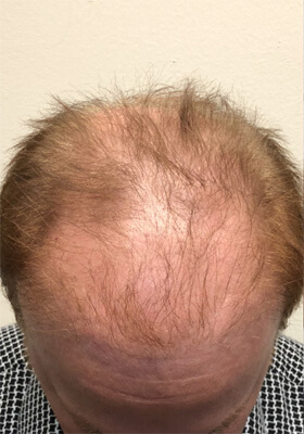 hair transplant photos