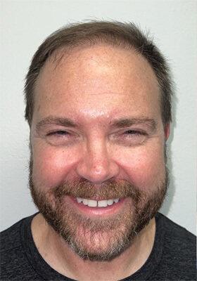 hair transplant photos