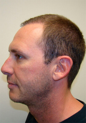 hair transplant photos