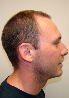 hair transplant photos