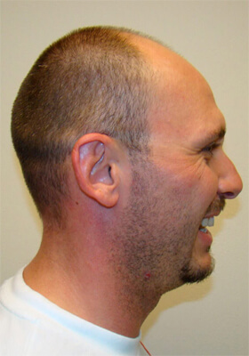 hair transplant photos