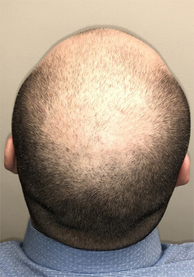 hair transplant before after Photos