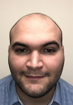 hair transplant photos