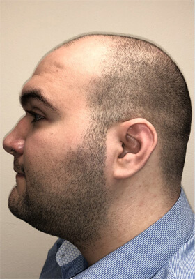 hair transplant photos