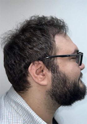 hair transplant photos