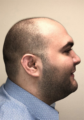 hair transplant photos