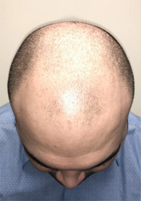 hair transplant photos