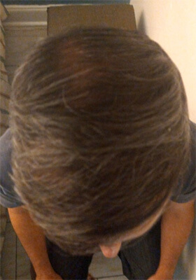 hair transplant photos