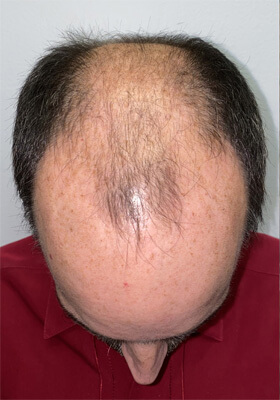 hair transplant before after Photos