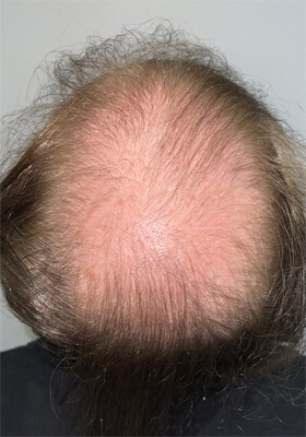 hair transplant before after Photos