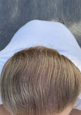 hair transplant before after Photos