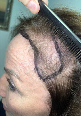 hair transplant photos