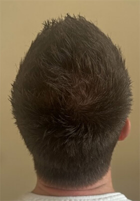 hair transplant photos