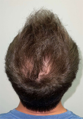 hair transplant photos