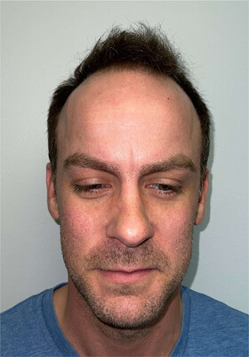 hair transplant photos