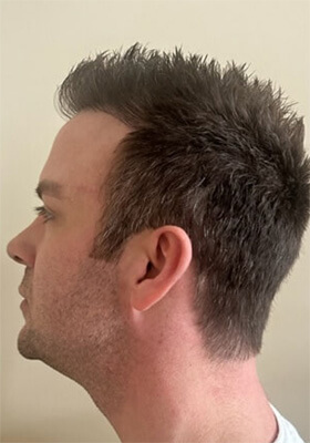 hair transplant photos