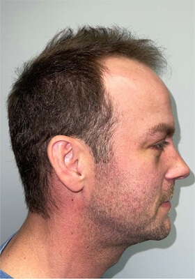 hair transplant photos