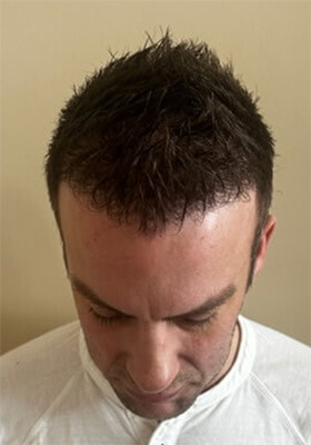 hair transplant photos