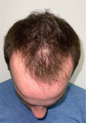 hair transplant photos