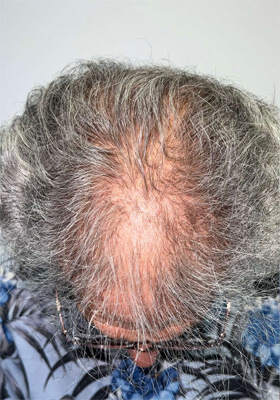 hair transplant before after Photos