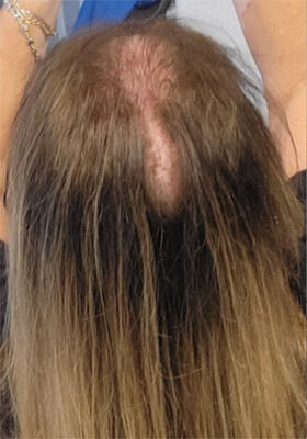 hair transplant photos