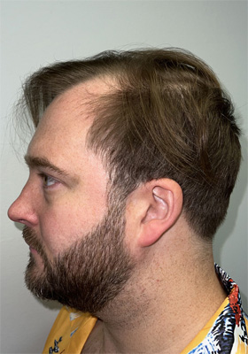 hair transplant photos