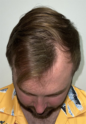 hair transplant photos