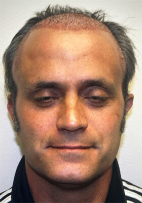 hair transplant photos