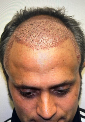 hair transplant photos