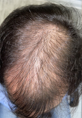 hair transplant photos