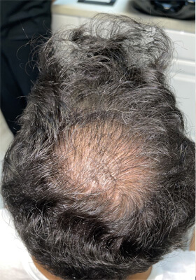 hair transplant before after Photos