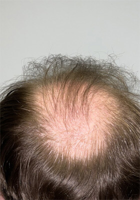 hair transplant photos