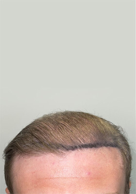 hair transplant photos