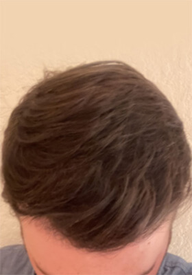 hair transplant photos