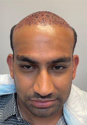 hair transplant photos