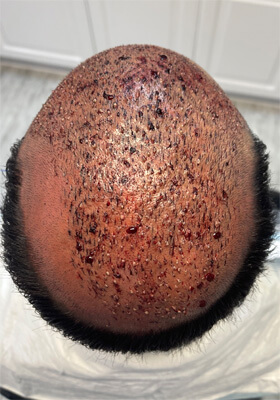 hair transplant photos